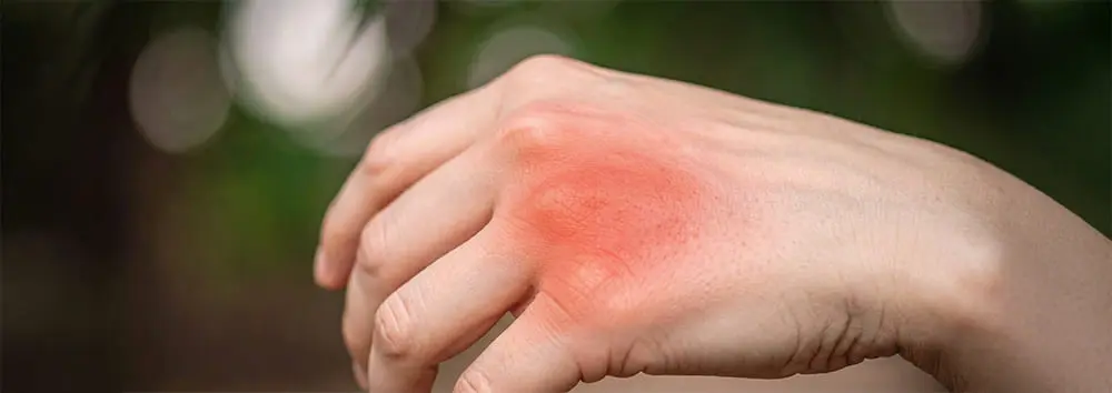 Brûlure : identifier la gravité et appliquer les bons gestes de secours