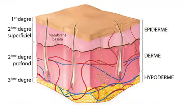 Schéma des tissus de la peau coincident avec les différents degré de brûlure