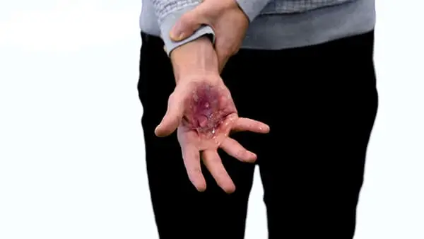 Brûlure grave de la main